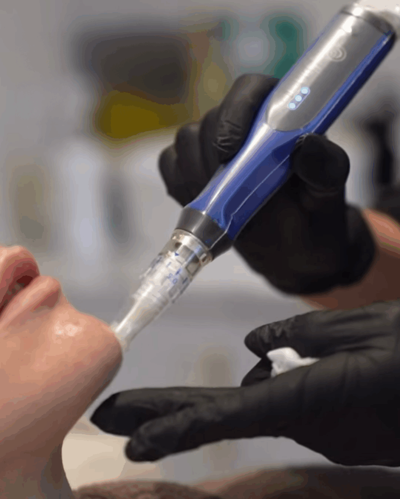 skinpen behandlung bei saranda ogradnig medical skincare effektive minimalinvasive anti aging laserbehandlung nahaufnahme