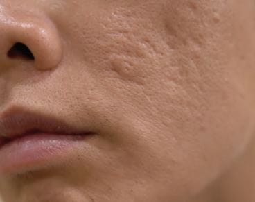 Skinpen Indikation Akne