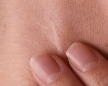 Skinpen Indikation Operationsnarben
