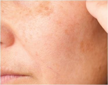 Skinpen Indikation Pigmentierungsstörungen