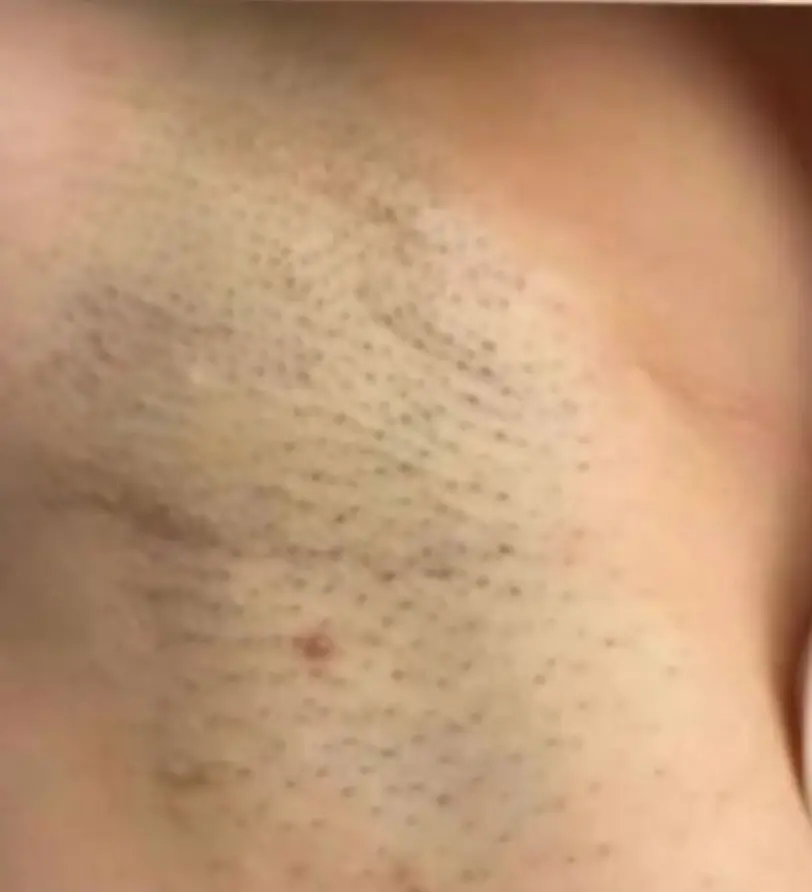 Achsel Frau vor Laserhaarentfernung